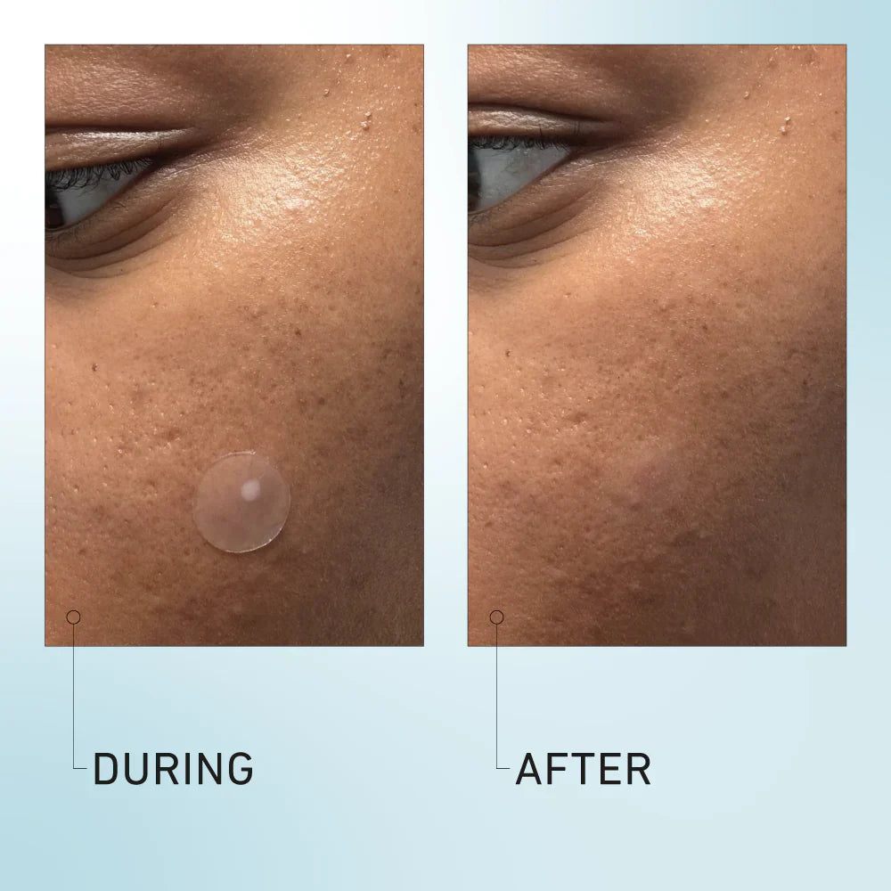 Good Light Luna Pimple Patches