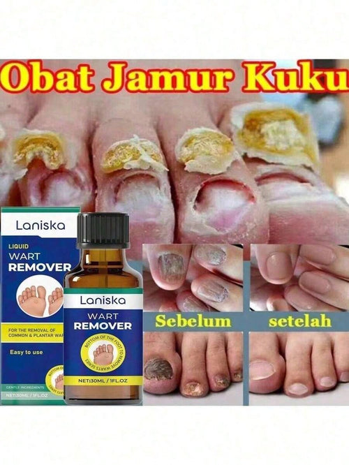 Nail Fungus Treatment Essence Cream Antifungal Gel Anti Infection Onychomycosis Paronychia Nursing