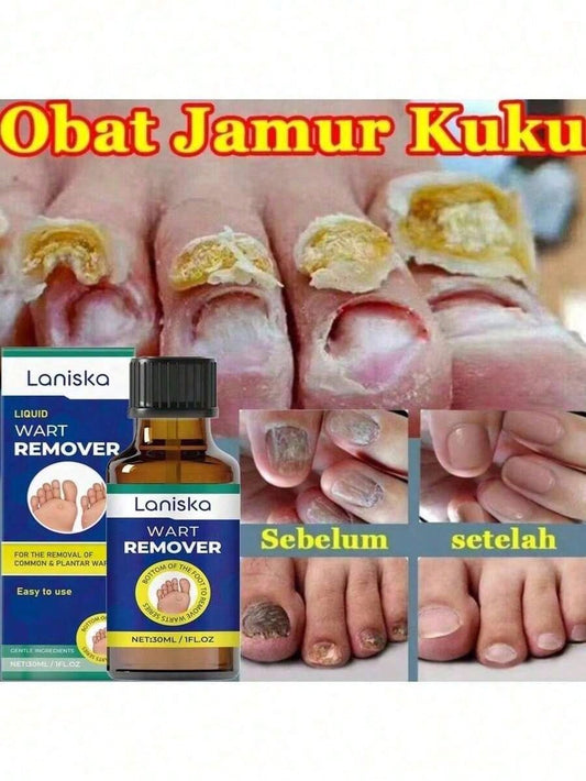 Nail Fungus Treatment Essence Cream Antifungal Gel Anti Infection Onychomycosis Paronychia Nursing