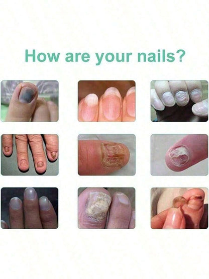 Nail Fungus Treatment Essence Cream Antifungal Gel Anti Infection Onychomycosis Paronychia Nursing