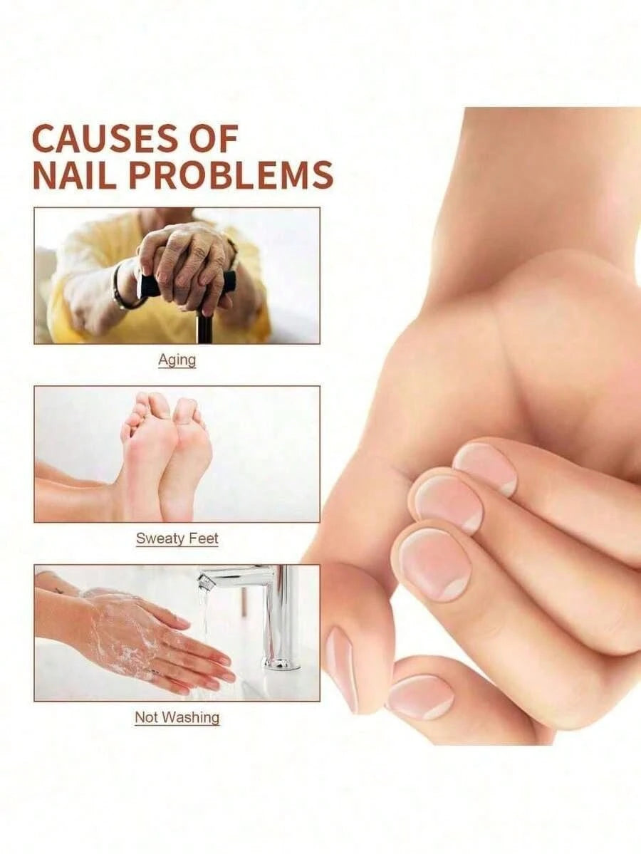 Nail Fungus Treatment Essence Cream Antifungal Gel Anti Infection Onychomycosis Paronychia Nursing