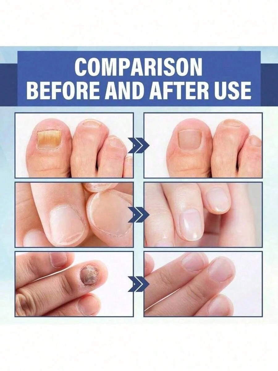 Nail Fungus Treatment Essence Cream Antifungal Gel Anti Infection Onychomycosis Paronychia Nursing