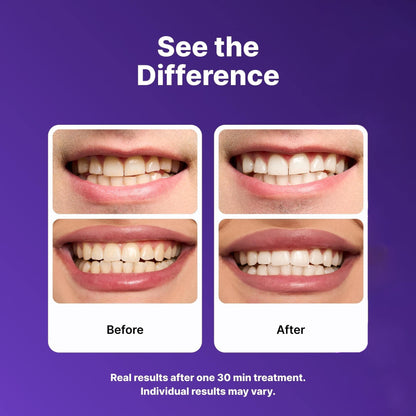 Purple Teeth Whitening Strips 21 Treatments- Safety For Enamel- Non Sensitive Teeth Whitening- Whitening Without Any Harm- Pack Of 42 Strips